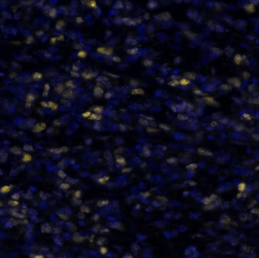 cMYC was detected in immersion fixed paraffin-embedded sections of human B-cell Lymphoma using Rabbit Anti-Human cMYC, Monoclonal Antibody (Catalog # NBP3-20492) at 5ug/mL at 37° Celsius for 4 minutes. Before incubation with the primary antibody, tissue underwent an all-in-one dewaxing and antigen retrieval preprocessing using PreTreatment Module (PT Module) and Dewax and HIER Buffer H (pH 9; Epredia Catalog # TA-999-DHBH). Tissue was stained using the Alexa Fluor™ Plus 647 Goat anti-Rabbit IgG Secondary Antibody at 1:200 at 37 ° Celsius for 2 minutes. (Yellow; Lunaphore Catalog # DR647RB) and counterstained with DAPI (blue; Lunaphore Catalog # DR100). Specific staining was localized to the nucleus. Protocol available in COMET™ Panel Builder.